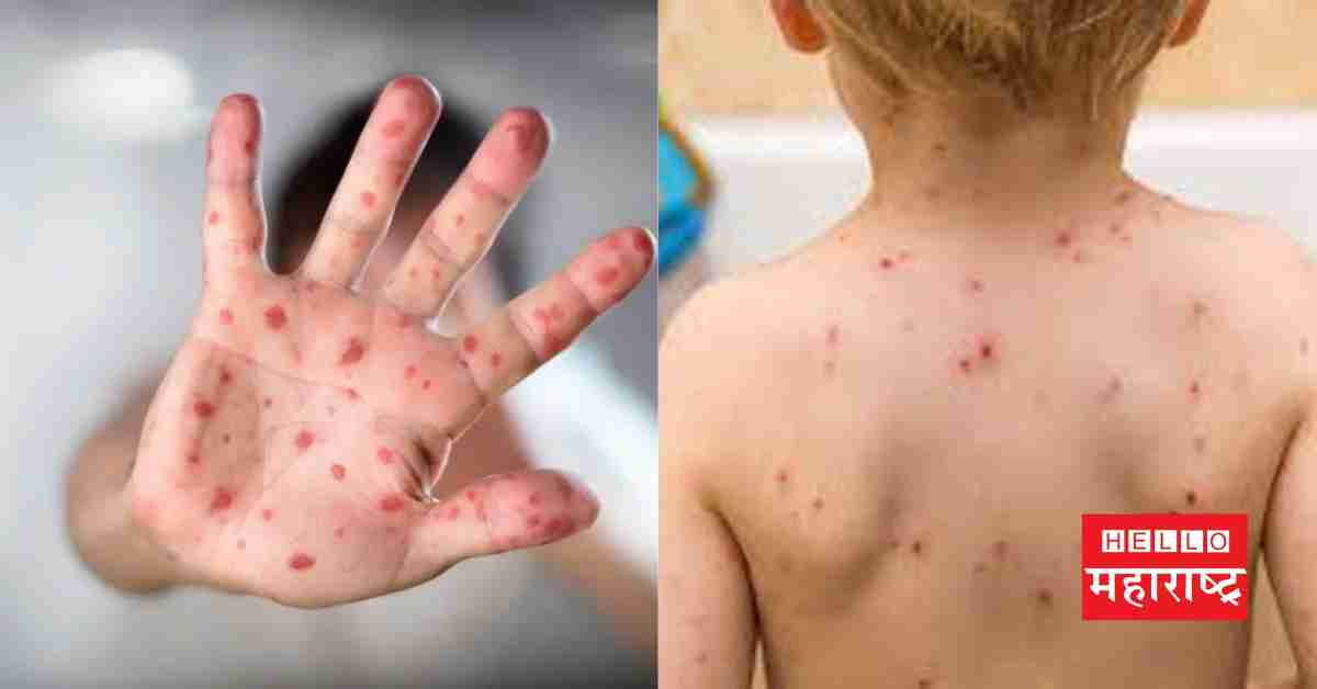 Measles Outbreak